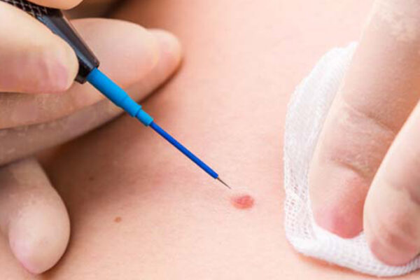 Hpv Tedavisi