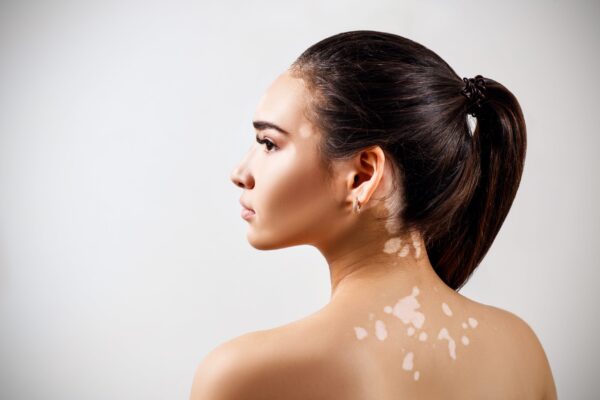 Vitiligo Tedavisi